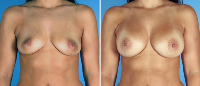 Before & After Breast Augmentation Case 17609 View #1 View in Alpharetta, GA