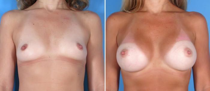 Before & After Breast Augmentation Case 17829 View #1 View in Alpharetta, GA