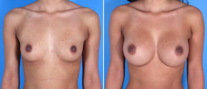 Before & After Breast Augmentation Case 17832 View #1 View in Alpharetta, GA