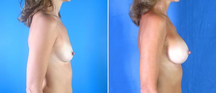 Before & After Breast Augmentation Case 17853 View #1 View in Alpharetta, GA