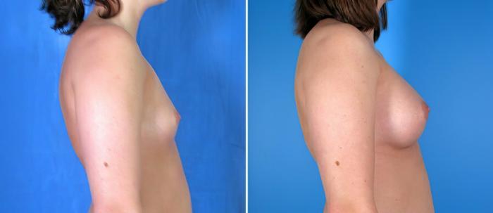 Before & After Breast Augmentation Case 17865 View #1 View in Alpharetta, GA