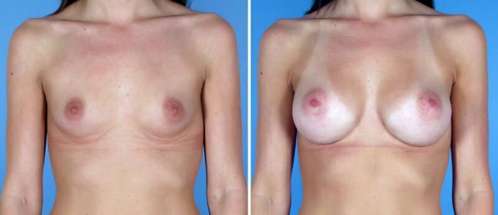 Before & After Breast Augmentation Case 19352 View #1 View in Alpharetta, GA
