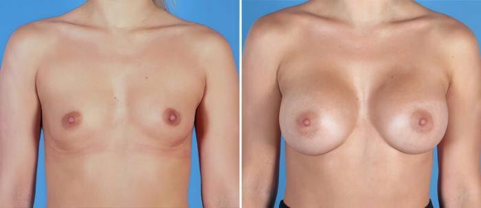 Before & After Breast Augmentation Case 24876 View #1 View in Alpharetta, GA