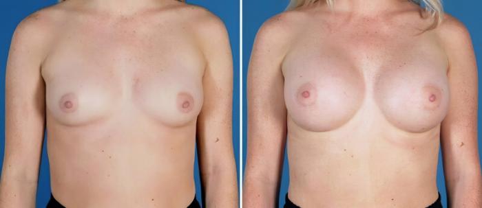 Before & After Breast Augmentation Case 24882 View #1 View in Alpharetta, GA