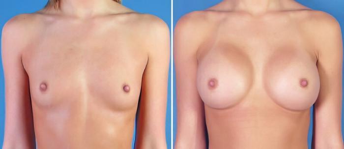 Before & After Breast Augmentation Case 24894 View #1 View in Alpharetta, GA
