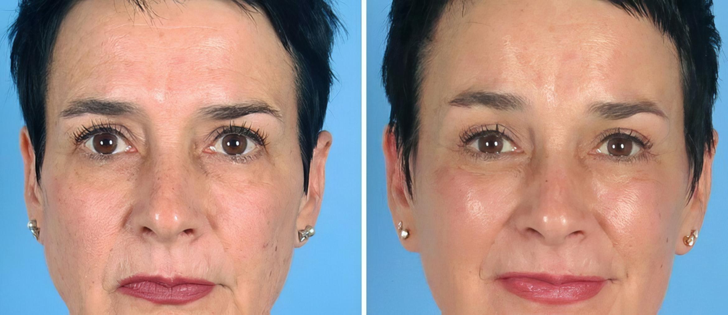 Before & After Brow Lift Case 19548 View #1 View in Alpharetta, GA