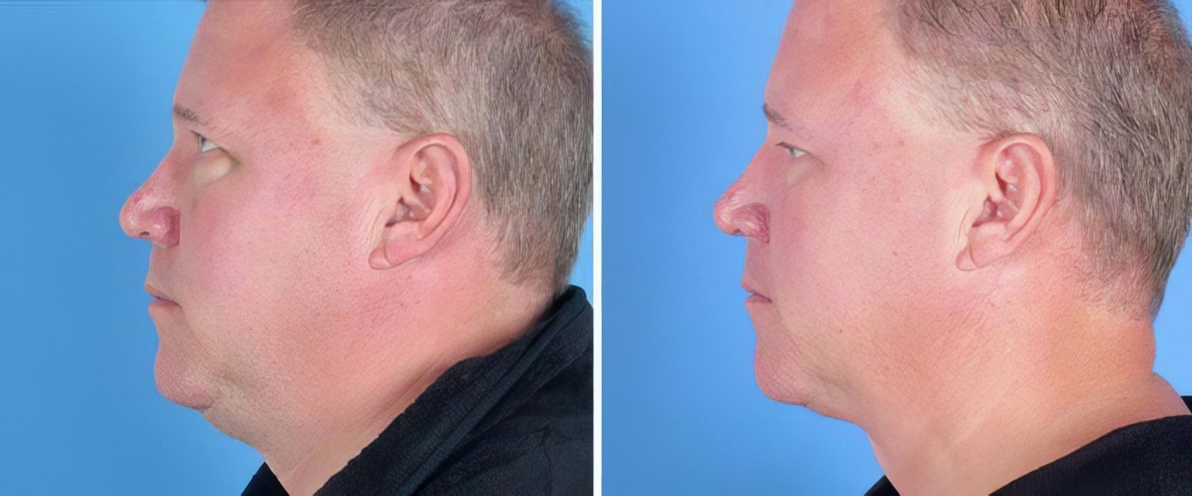 Before & After Chin & Neck Liposuction Case 25519 View #2 View in Alpharetta, GA