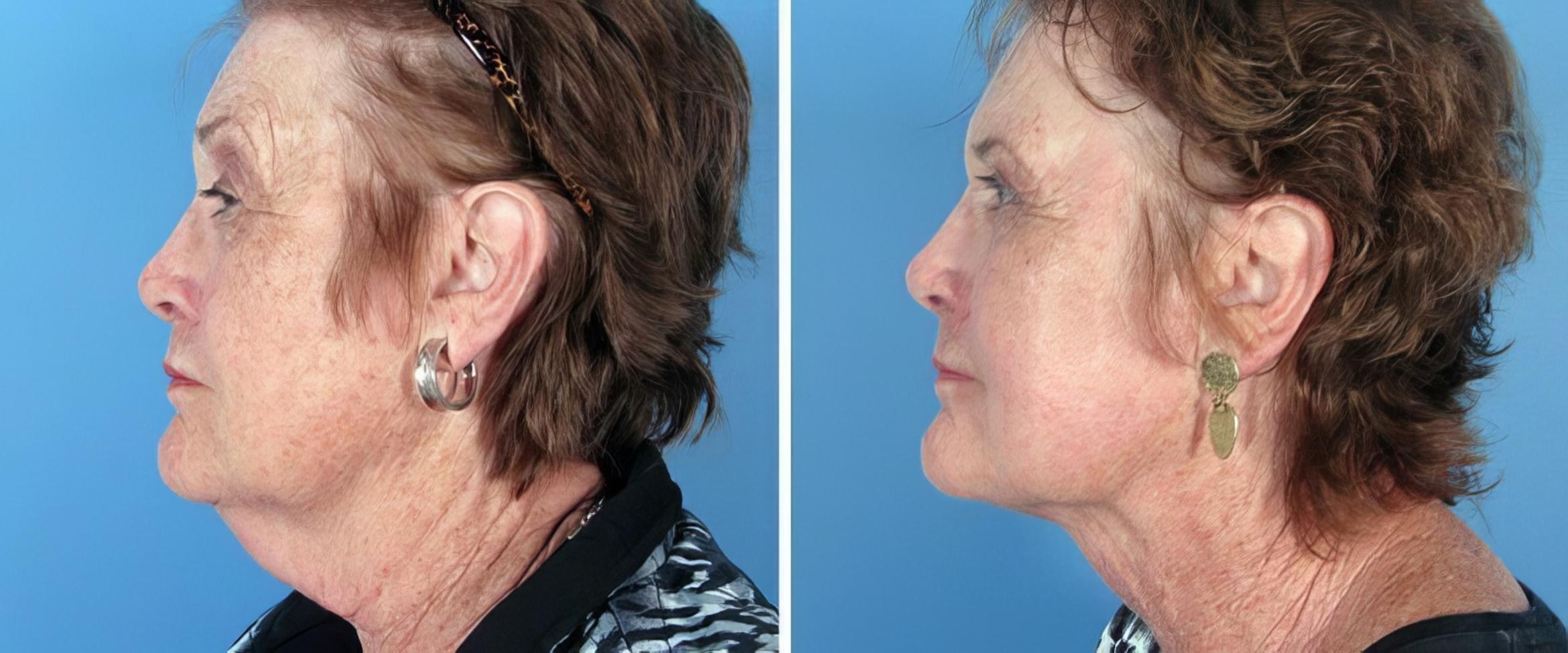 Before & After Chin & Neck Liposuction Case 25797 View #2 View in Alpharetta, GA