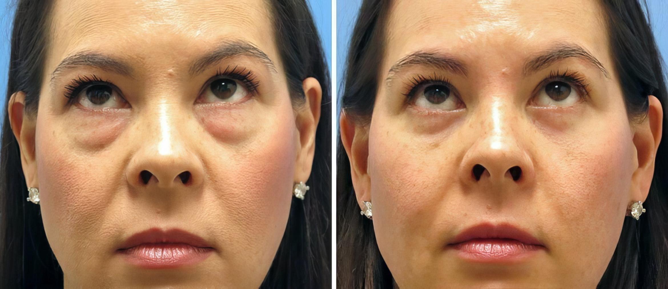 Before & After Eyelid Lift Case 17743 View #2 View in Alpharetta, GA
