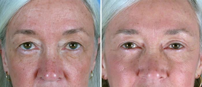 Before & After Eyelid Lift Case 19257 View #1 View in Alpharetta, GA