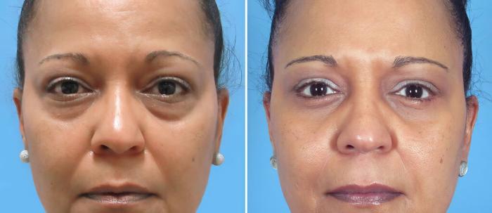 Before & After Eyelid Lift Case 26149 View #1 View in Alpharetta, GA