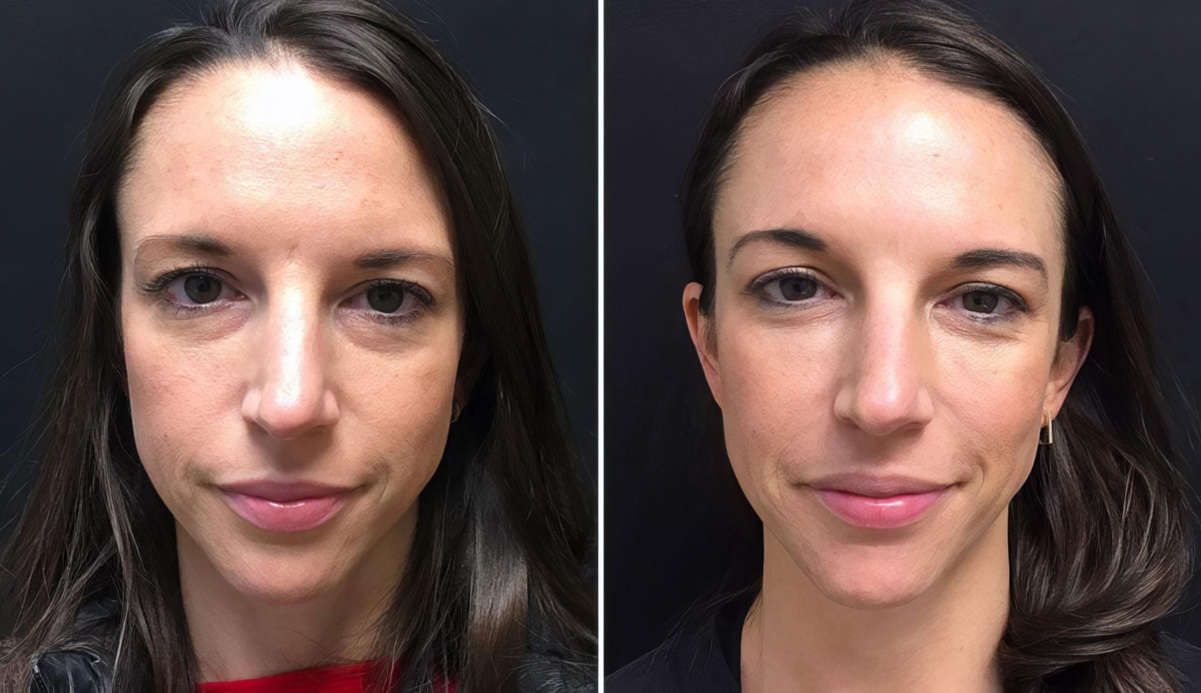 Before & After Injectables & Fillers Case 26676 View #1 View in Alpharetta, GA