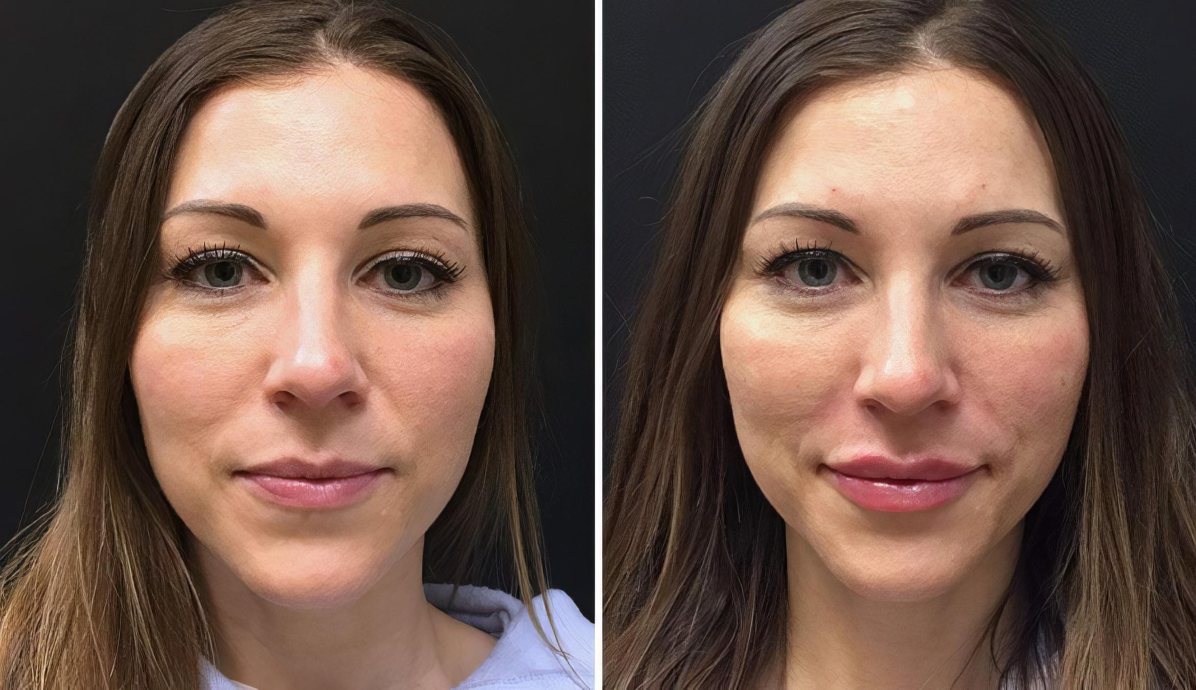 Before & After Injectables & Fillers Case 26788 View #1 View in Alpharetta, GA