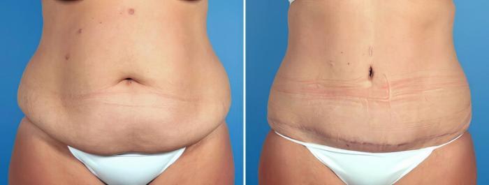 Before & After Tummy Tuck Case 16966 View #1 View in Alpharetta, GA