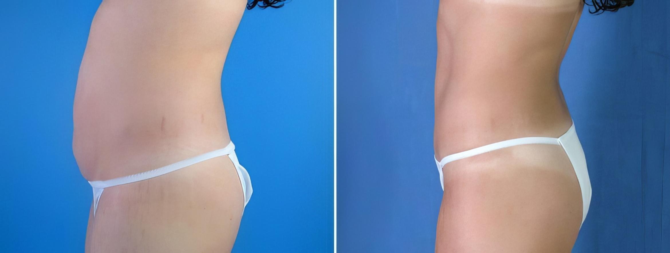 Before & After Tummy Tuck Case 17874 View #1 View in Alpharetta, GA