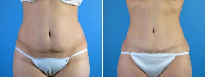 Before & After Tummy Tuck Case 17918 View #1 View in Alpharetta, GA