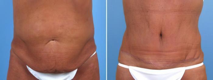 Before & After Tummy Tuck Case 18105 View #1 View in Alpharetta, GA