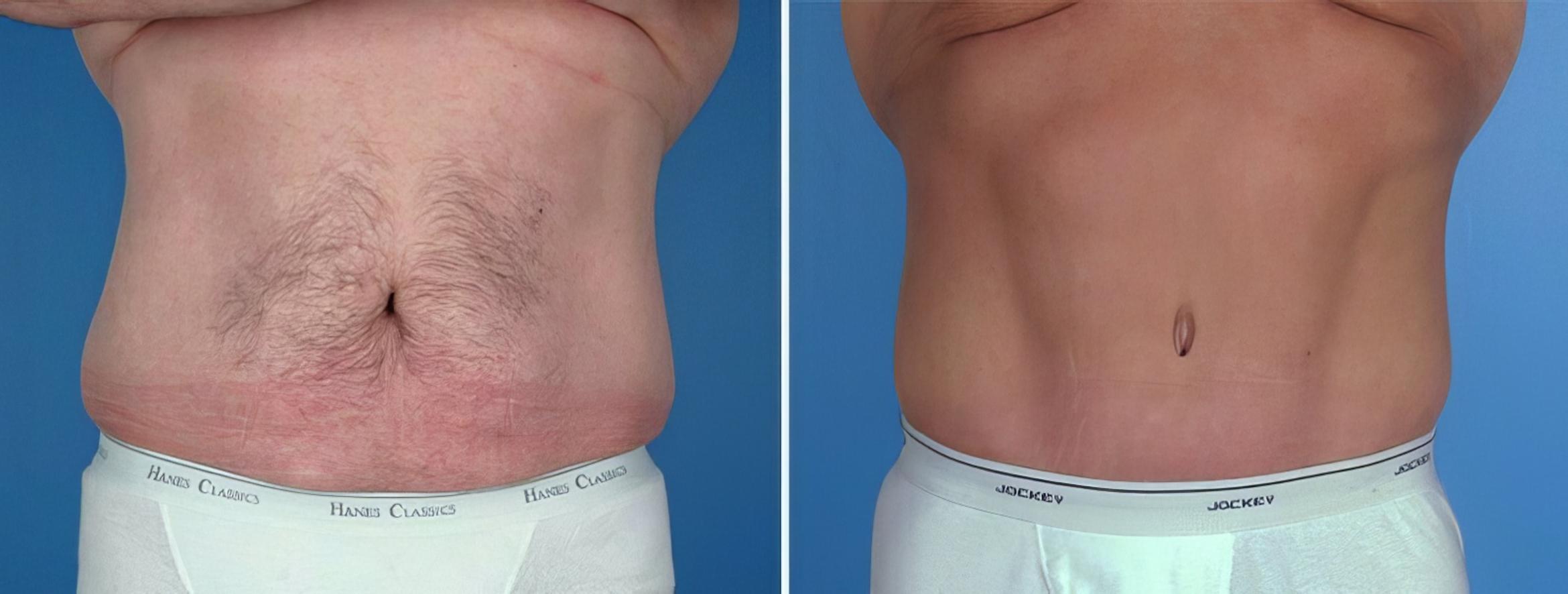 Before & After Tummy Tuck Case 25017 View #1 View in Alpharetta, GA