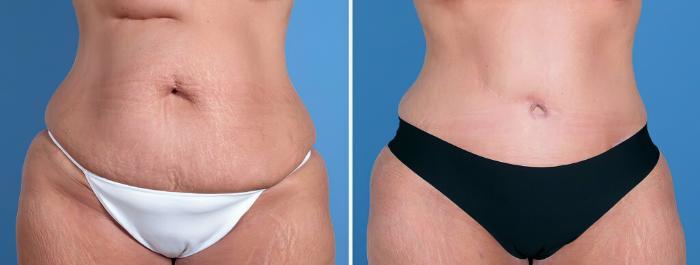 Before & After Tummy Tuck Case 26215 View #1 View in Alpharetta, GA