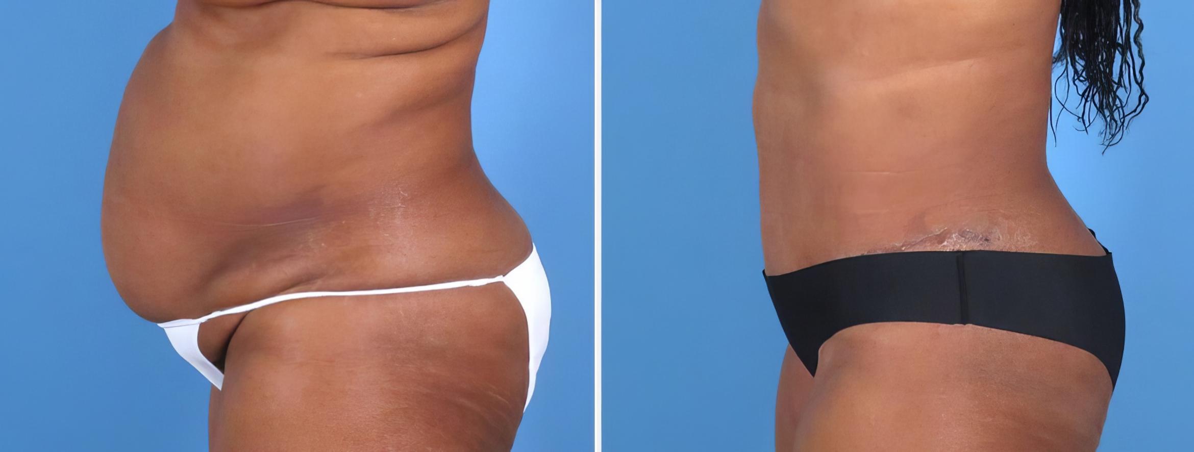 Before & After Tummy Tuck Case 27022 View #3 View in Alpharetta, GA