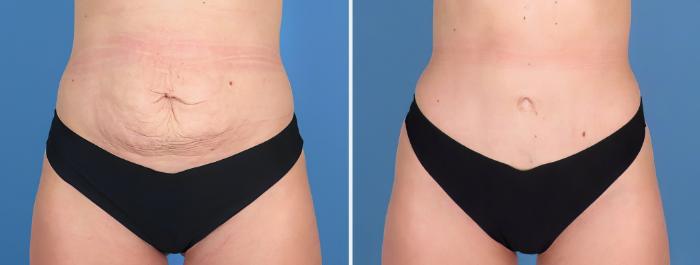 Before & After Tummy Tuck Case 27155 View #1 View in Alpharetta, GA