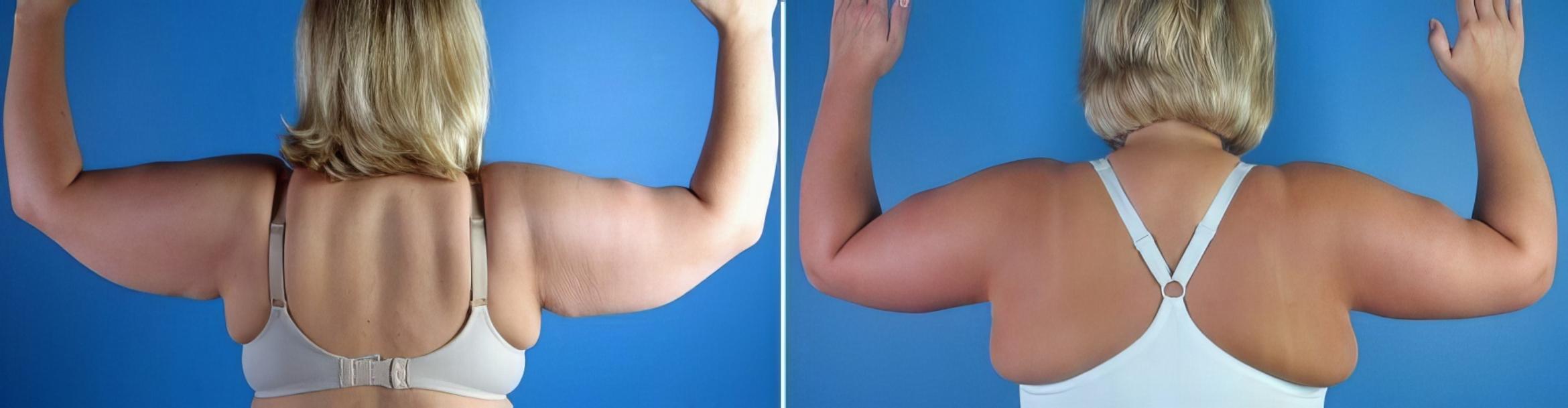Before & After Arm Lift Case 17350 View #1 View in Alpharetta, GA
