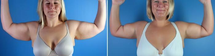 Before & After Arm Lift Case 17350 View #2 View in Alpharetta, GA