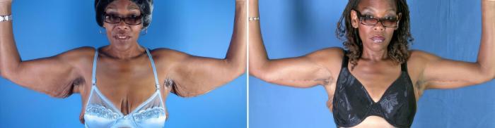 Before & After Arm Lift Case 17792 View #2 View in Alpharetta, GA