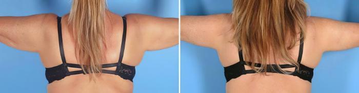 Before & After Arm Lift Case 19391 View #1 View in Alpharetta, GA