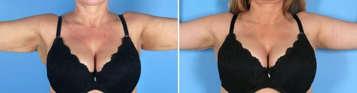 Before & After Arm Lift Case 19391 View #2 View in Alpharetta, GA