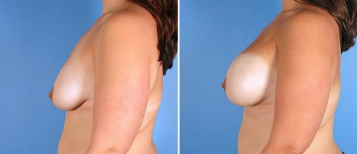 Before & After Breast Asymmetry Case 18198 View #2 View in Alpharetta, GA