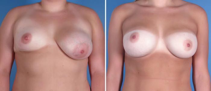 Before & After Breast Asymmetry Case 18201 View #1 View in Alpharetta, GA