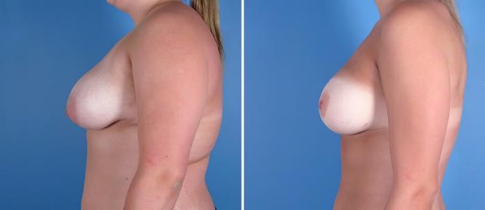 Before & After Breast Asymmetry Case 18201 View #2 View in Alpharetta, GA
