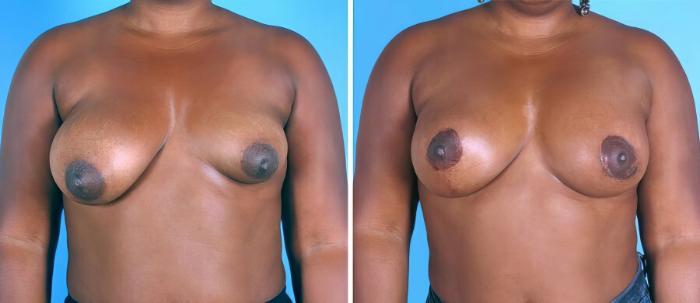 Before & After Breast Asymmetry Case 19289 View #1 View in Alpharetta, GA