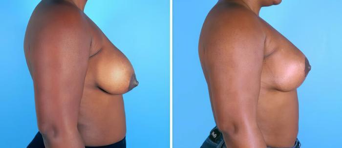 Before & After Breast Asymmetry Case 19289 View #2 View in Alpharetta, GA