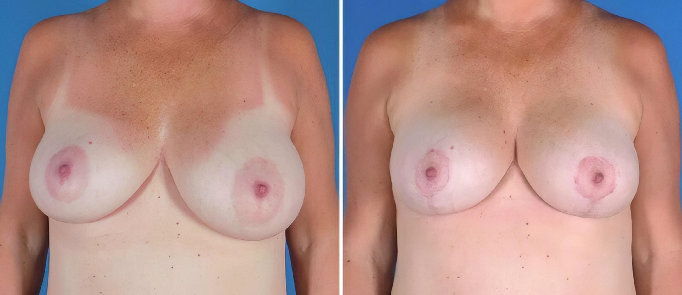 Before & After Breast Asymmetry Case 22918 View #1 View in Alpharetta, GA