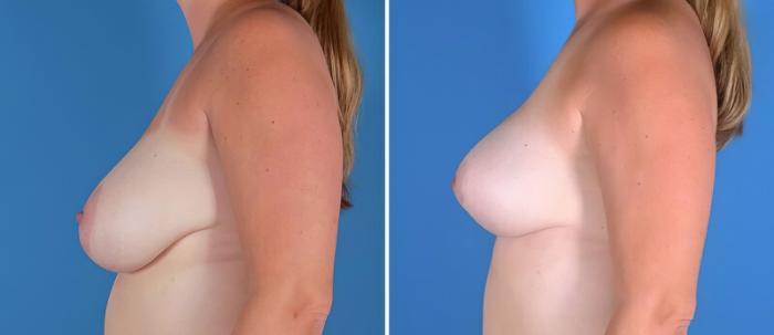 Before & After Breast Asymmetry Case 22918 View #2 View in Alpharetta, GA