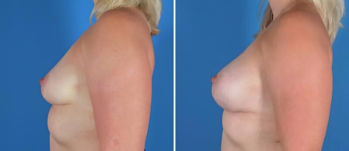 Before & After Breast Asymmetry Case 22921 View #2 View in Alpharetta, GA