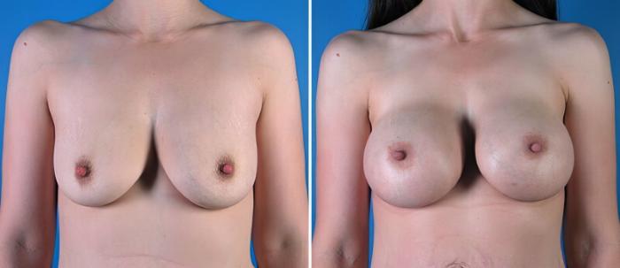 Before & After Breast Asymmetry Case 25782 View #1 View in Alpharetta, GA
