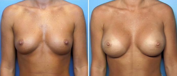 Before & After Breast Augmentation Case 16414 View #1 View in Alpharetta, GA