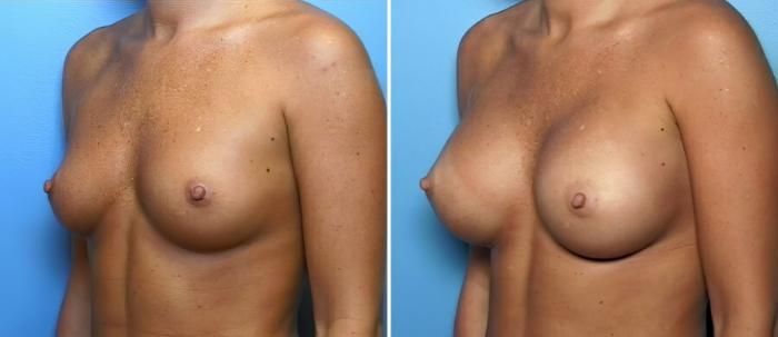 Before & After Breast Augmentation Case 16414 View #2 View in Alpharetta, GA