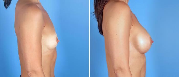 Before & After Breast Augmentation Case 17088 View #2 View in Alpharetta, GA