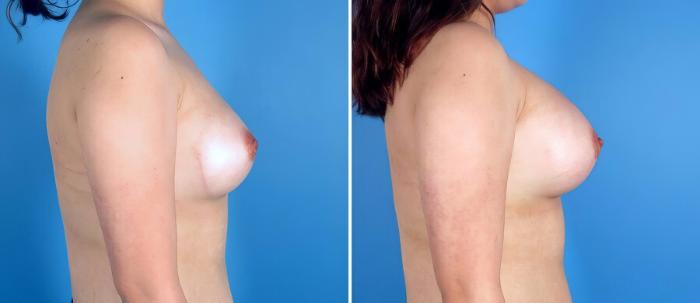 Before & After Breast Augmentation Case 17091 View #2 View in Alpharetta, GA