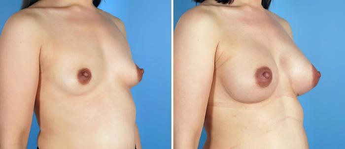 Before & After Breast Augmentation Case 17094 View #2 View in Alpharetta, GA