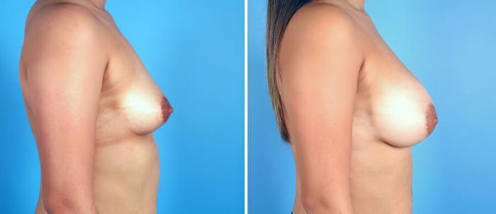 Before & After Breast Augmentation Case 17100 View #2 View in Alpharetta, GA