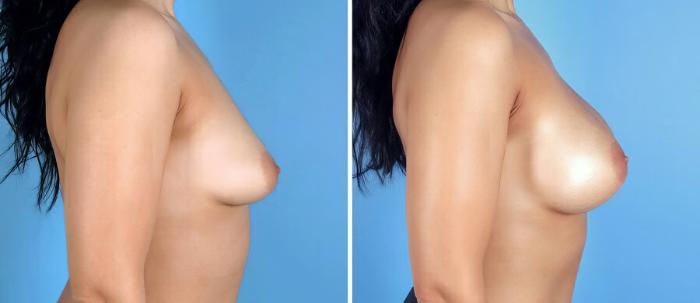 Before & After Breast Augmentation Case 17103 View #2 View in Alpharetta, GA