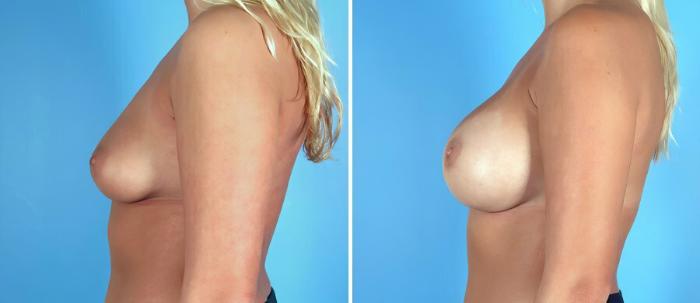 Before & After Breast Augmentation Case 17106 View #2 View in Alpharetta, GA