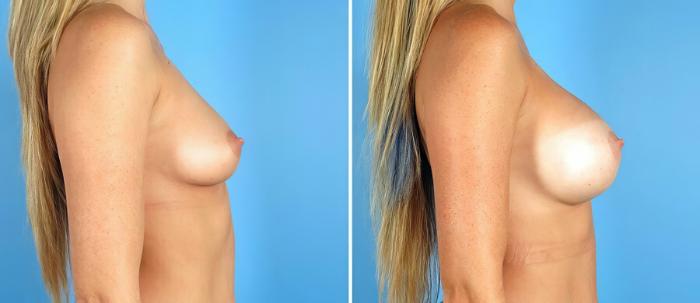 Before & After Breast Augmentation Case 17603 View #2 View in Alpharetta, GA