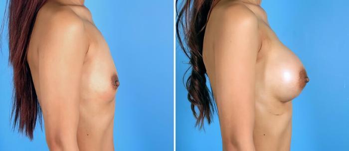 Before & After Breast Augmentation Case 17606 View #2 View in Alpharetta, GA