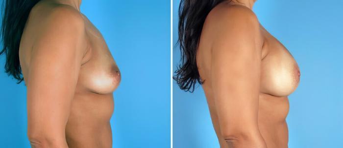 Before & After Breast Augmentation Case 17609 View #2 View in Alpharetta, GA
